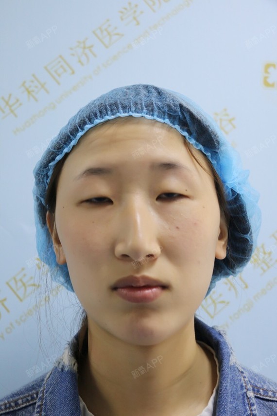 本人天生上睑下垂整体像没睡醒样的双眼无神目光呆滞最近了解到上睑