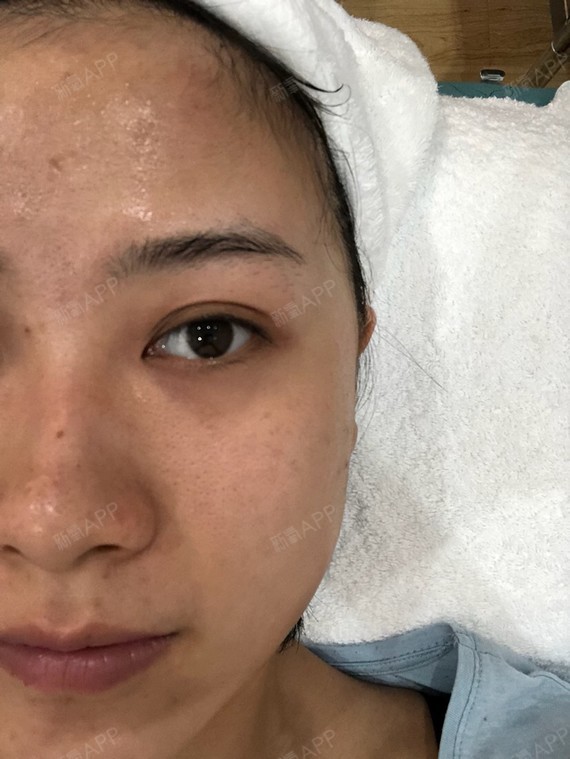 重庆光子嫩肤好不好_效果图_氧气x89gu光子嫩肤术后第22天_新氧美容