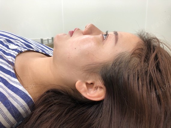 隆鼻 | 膨体隆鼻 | 术后当自强 | 成都同城 | 鼻部综合 | 肋软骨隆鼻