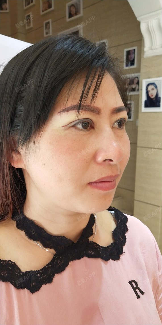 设计为自然宽度5mm,增加了眼尾提升的项目,术后即刻改善效果