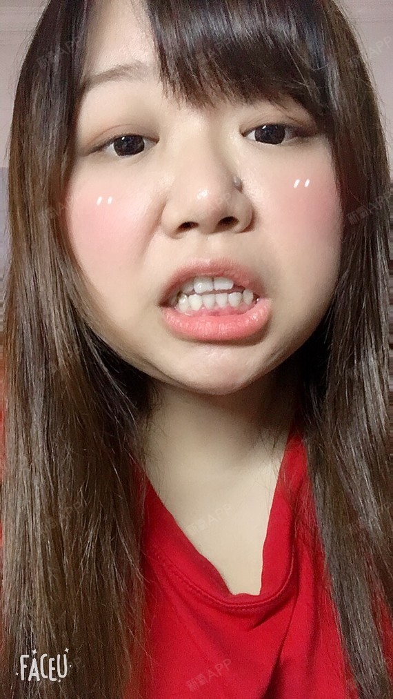 看着牙齿一点点排齐,可以说是非常开心了,上面这张是没戴着牙套的牙齿