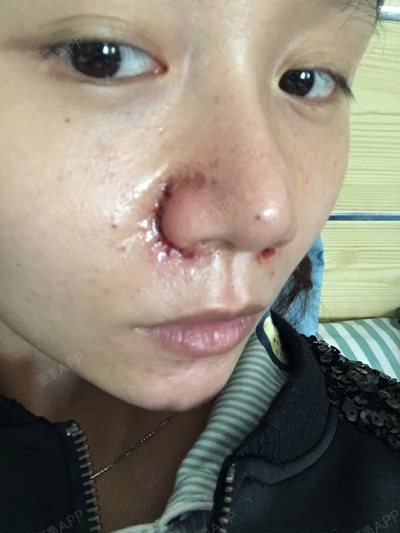 所以说会用内切的方式尽量调整高度～然后鼻翼缩小如果外切的话,疤痕