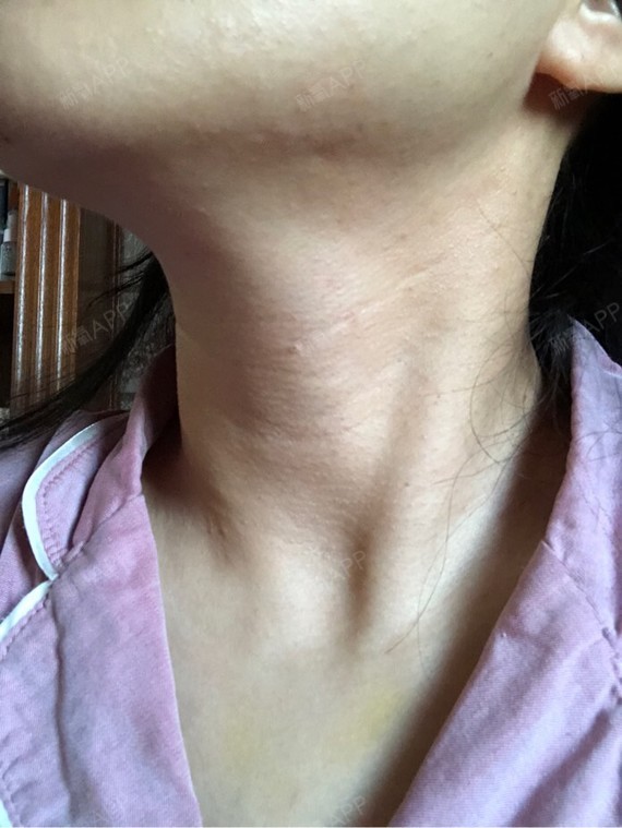 去颈纹鸡皮疙瘩怎么办(蛇皮纹鸡皮疙瘩怎么去除) 去颈纹鸡皮疙瘩怎么办(蛇皮纹鸡皮疙瘩怎么去除)