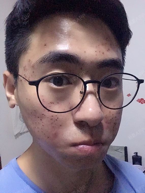 感觉没有像素激光面积大做完以后脸上像长满了麻子