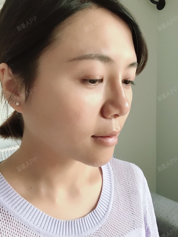 玻尿酸丰鼻基底好不好_效果图_232007玻尿酸丰鼻基底术后第9天_新氧