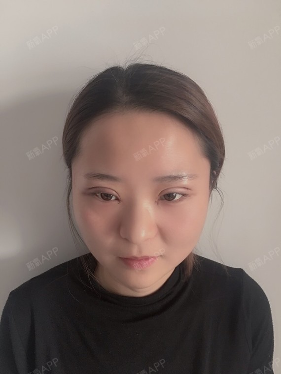 氧气yrsjk开外眼角第2天美丽日记