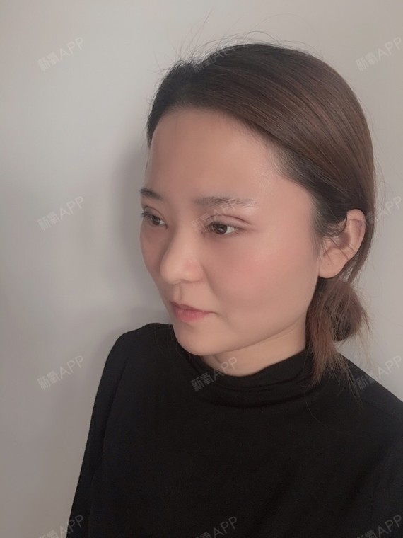 氧气yrsjk开外眼角第2天美丽日记