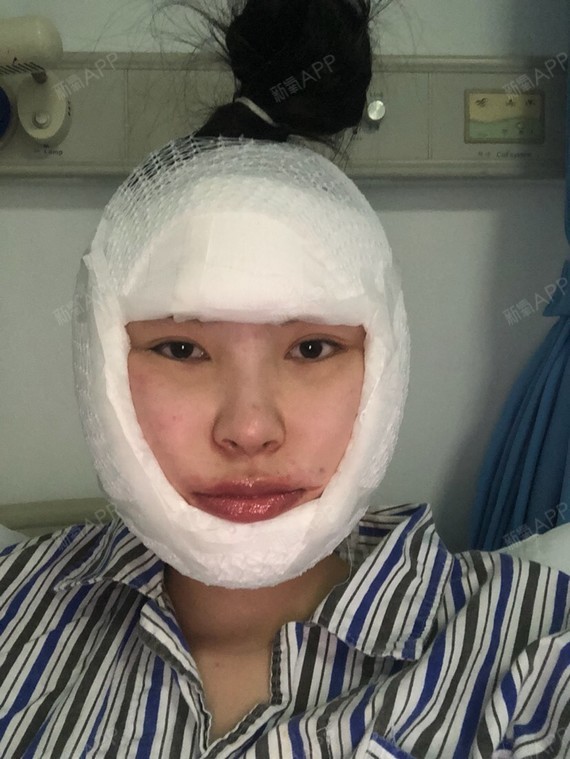 角整形好不好_效果图_豆子会变美下颌角整形术后第3天_新氧美容整形