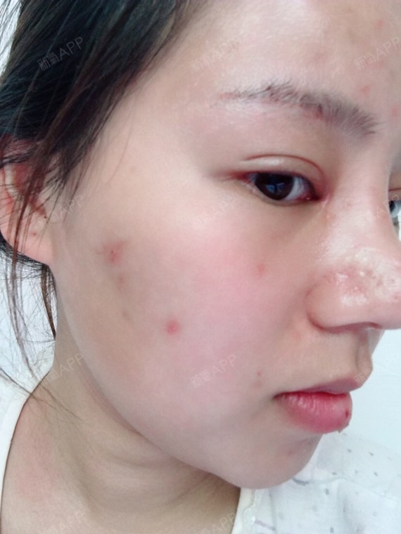 氧气hyb12a5清痘针第73天美丽日记