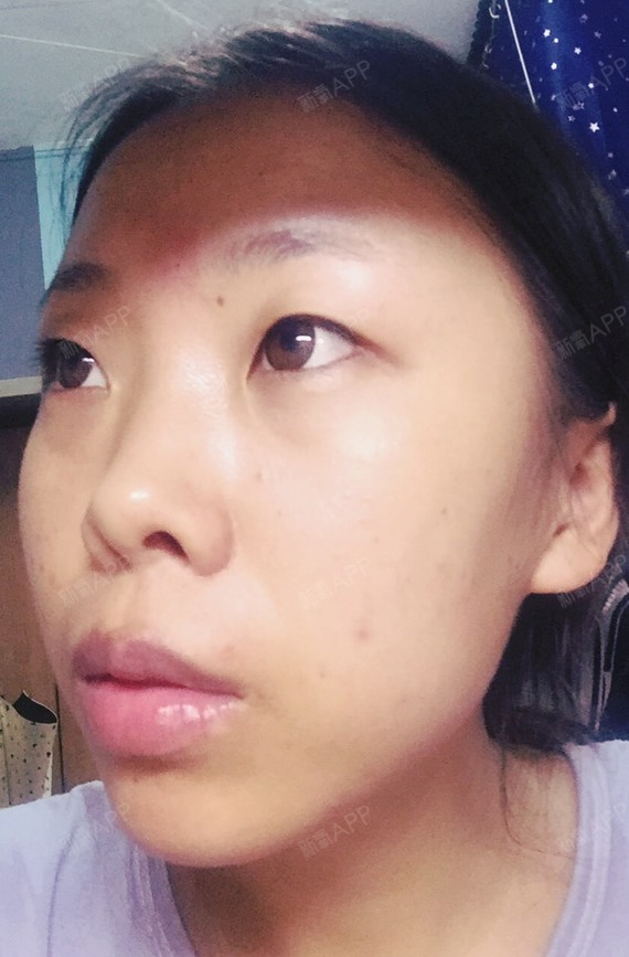 上眼睑去脂好不好_效果图_氧气ybr9g上眼睑去脂术后第16天_新氧美容