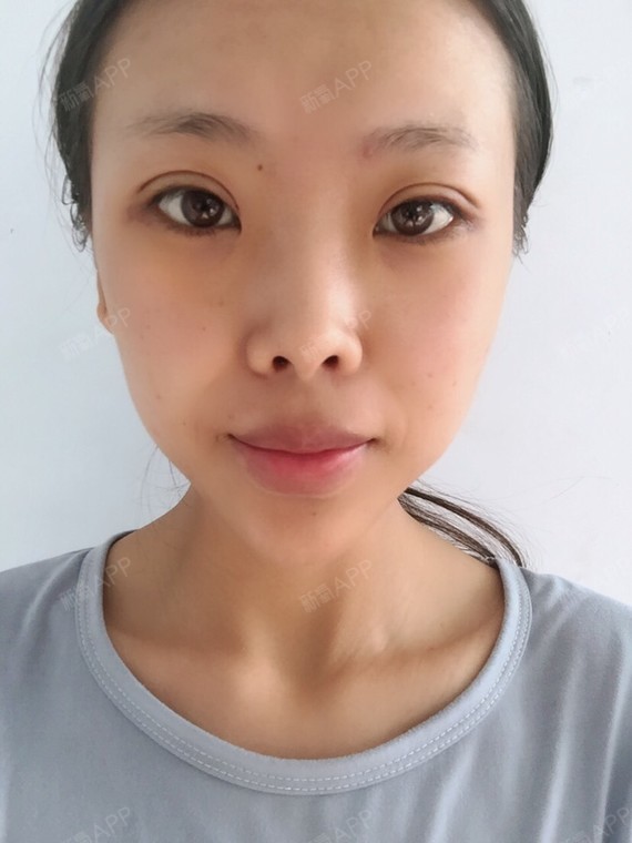 上眼睑去脂好不好_效果图_氧气ybr9g上眼睑去脂术后第16天_新氧美容