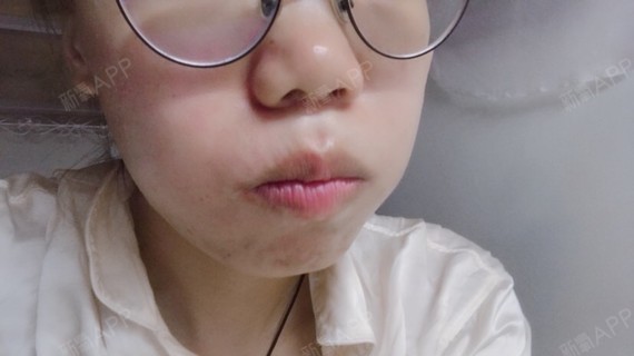 我的问题是牙齿拥挤,不齐,有一颗多生牙,嘴唇比较厚_圈子-新氧美容