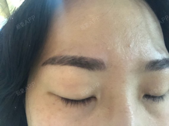 纹眉后第二天 右眉尾有点掉色 其他除了颜色浓 不太 圈子 新氧美容整形 纹眉后第二天 右眉尾有点掉色 其他除了颜色浓 不太 圈子 新氧美容整形