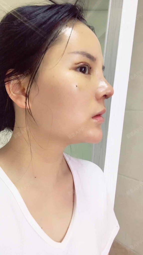 肋软骨隆鼻好不好_效果图_justdance肋软骨隆鼻术后第9天_新氧美容