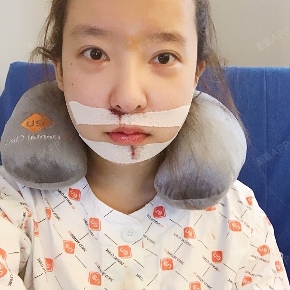 下颚前突/地包天好不好_效果图_白小樱下颚前突/地包天术后第2天_新氧