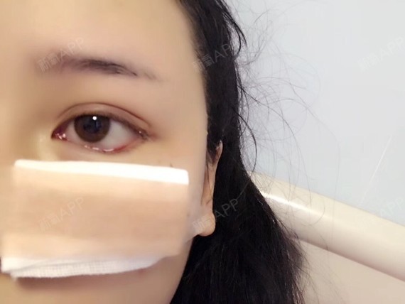 这是我做好下至外眼角手术的第二天,没有明显夸张的血_圈子-新氧美容