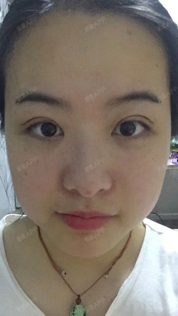 氧气hcse467切开双眼皮第4天美丽日记