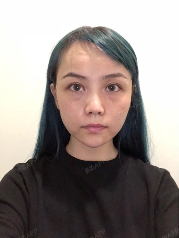 我要做颗好苹果玻尿酸丰卧蚕第2天美丽日记