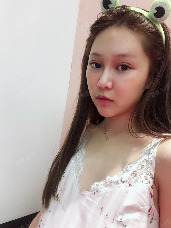 拆完线之后,我现在天天在朋友圈发照片,故意把胸露一_圈子-新氧美容