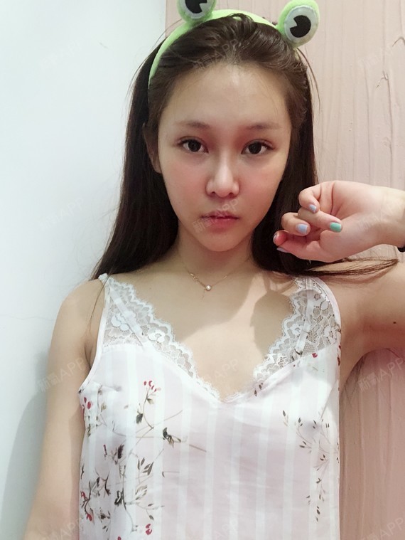 拆完线之后,我现在天天在朋友圈发照片,故意把胸露一_圈子-新氧美容