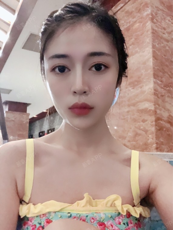 这是注射完瘦脸针的第六天,已经感觉咬肌部分明显变小_圈子-新氧美容