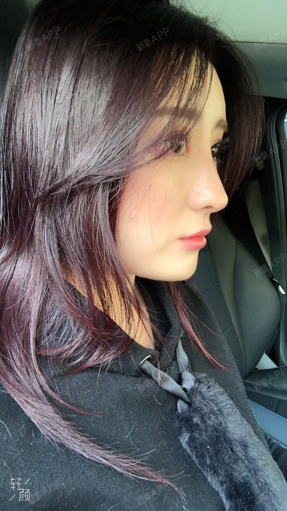 肋软骨隆鼻好不好_效果图_氧气yn9dr肋软骨隆鼻术后第30天_新氧美容