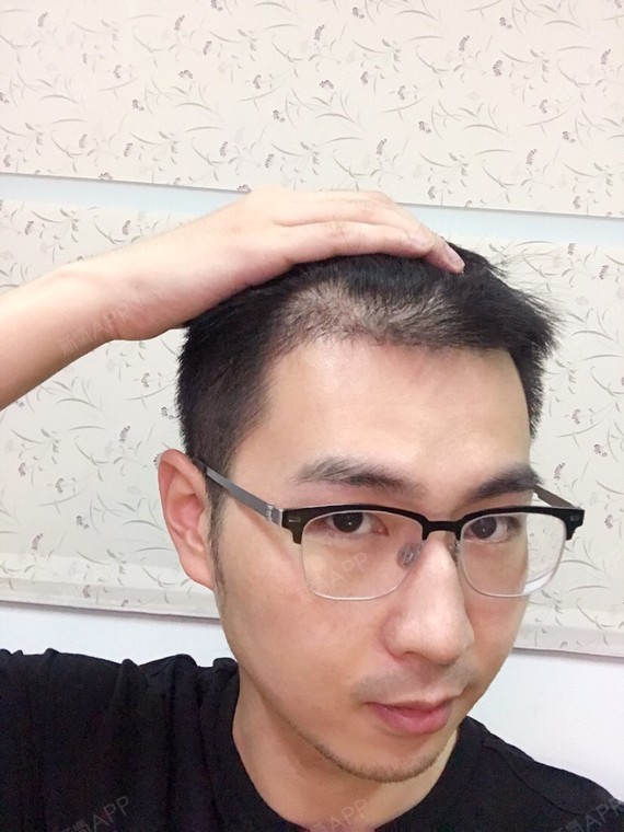 【杭州艺星植发术后第37天】现在头发有2cm长了,