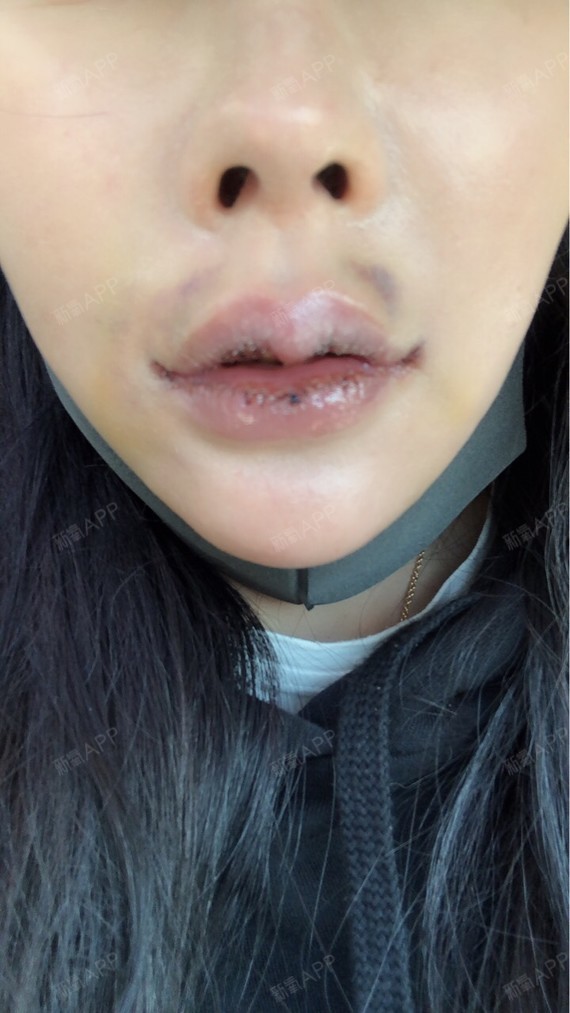 嘴角上扬术项目术后第5天