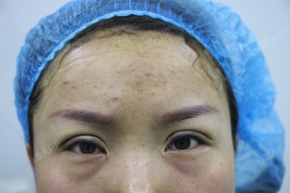 郑州上眼睑去脂好不好_效果图_氧气y3v75上眼睑去脂术后第0天_新氧