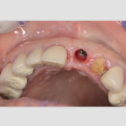 终于去做了种植牙