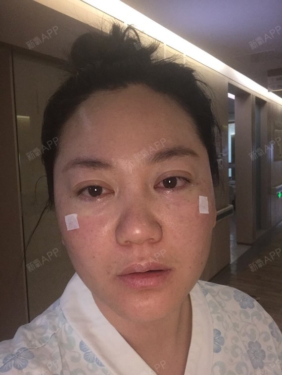 第一张刚下手术的照片和大腿取脂肪的照片,第三张是手术前眼袋