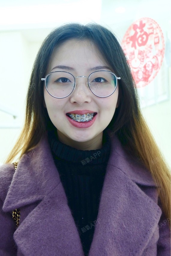 隐形托槽矫正