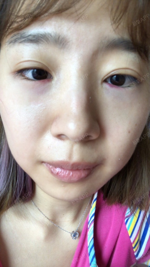 激光去眼袋