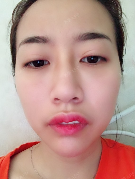 用玻尿酸打唇珠,期待玻尿酸能改善我人中短,嘴唇外翻_圈子-新氧美容