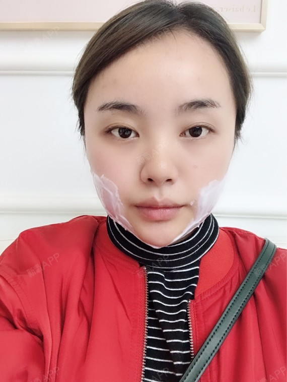 上有一直在了解的韩国6d小脸针据说一次相当于普通溶脂针三次的效果