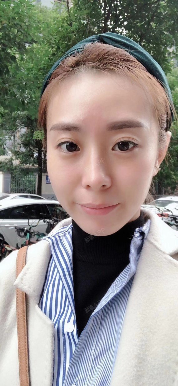 现在的下巴轮廓很自然了,不知道是我体质好的原因还是_圈子-新氧美容