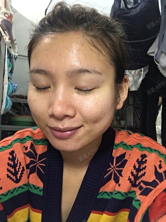 北京伊肤泉微针好不好_效果图_氧气yqel3伊肤泉微针术后第30天_新氧