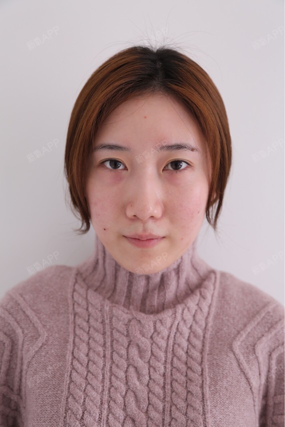 我的泪沟凹陷很明显,所以我想通过注射玻尿酸来填充.