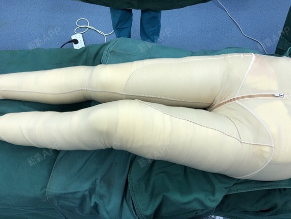 氧氧小女生射频溶脂瘦大腿第2天美丽日记