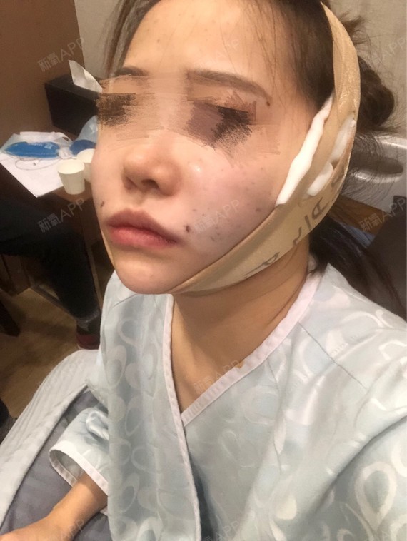手术埋线提升面吸一点点瘦脸针
