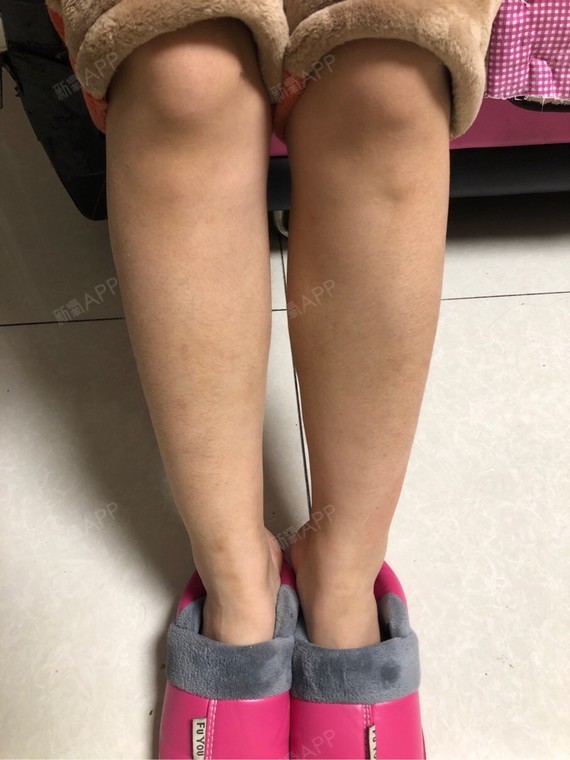 大姨妈来了特别痛吸脂瘦小腿术后第244天美丽日记_新氧整形