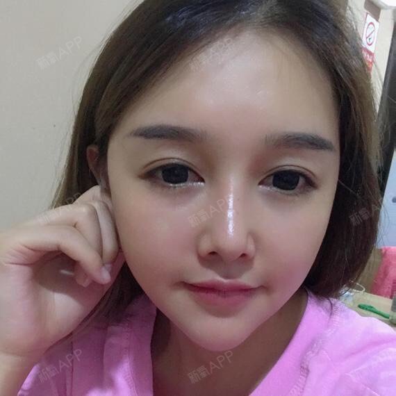 玻尿酸全脸填充