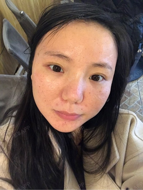 水光针第二天,脸上针眼清晰可见,唇边生了一些小龙包_圈子-新氧美容