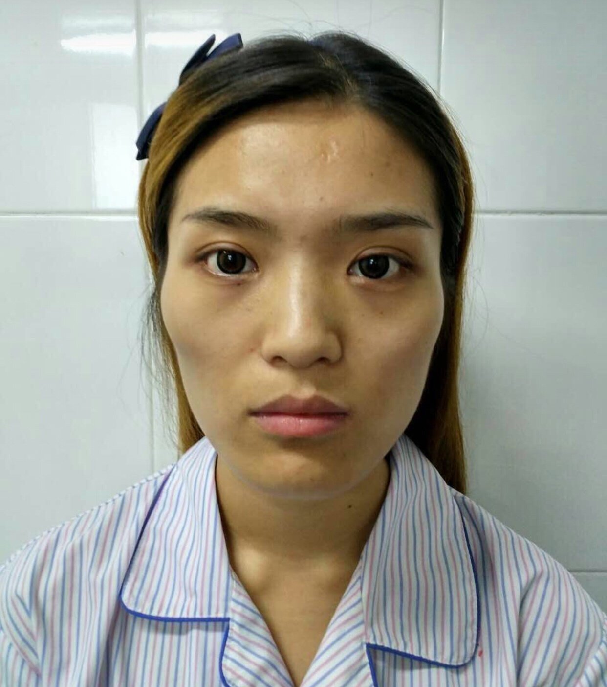 自体脂肪全脸填充第92天 · 第1篇日记