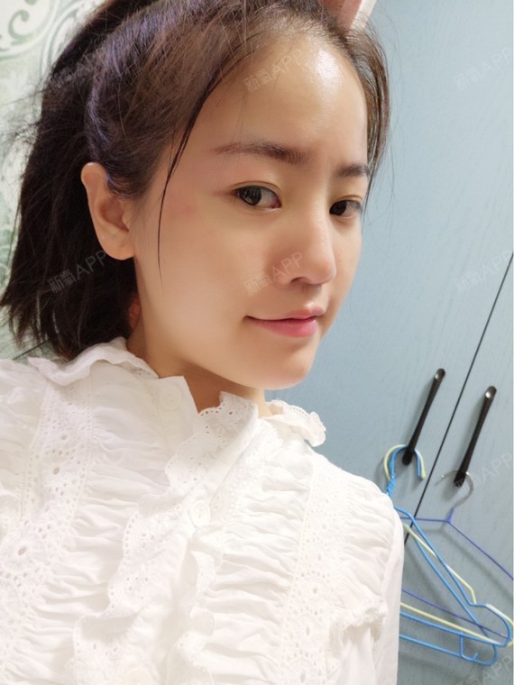 今天是打爱贝芙的第21天感觉鼻子没太大变化跟之前差_圈子-新氧美容