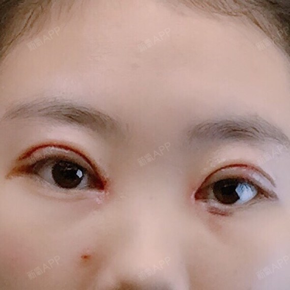 拆线后第一天的样子.  帮我看看会不会太宽啊.