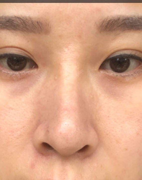 失败案例曝光失败案例双眼皮三点式定位77膨体隆鼻,双_圈子-新氧