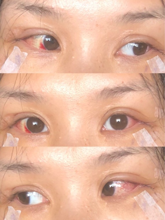 鱼儿酱酱酱开外眼角第3天美丽日记