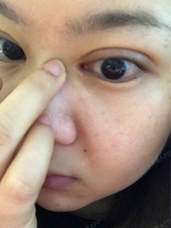 超级失败只能说 眼角像没开 疤痕超级严重 做鼻子的医生喊来做