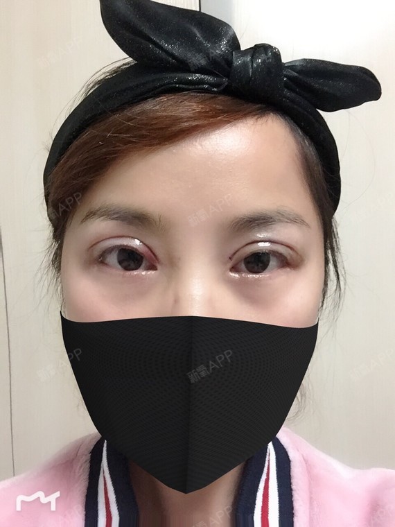 米娅2018 | 眼部 | 双眼皮 | 术后当自强 | 上海同城 | 定点双眼皮